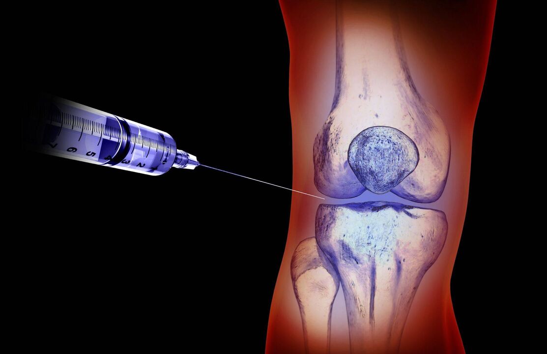 Injections intra-articulaires pour traiter l'arthropathie