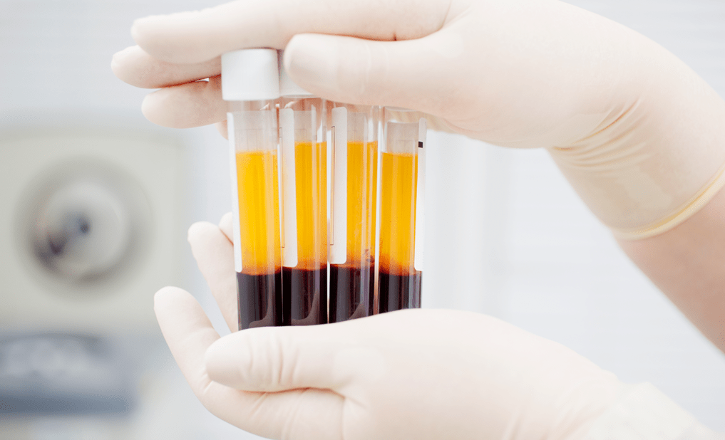 Plasma riche en plaquettes pour le traitement PRP de l'arthrite