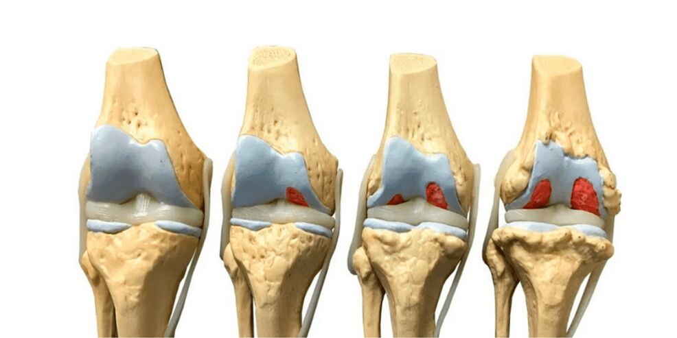 Degré d'arthrite dans l'articulation